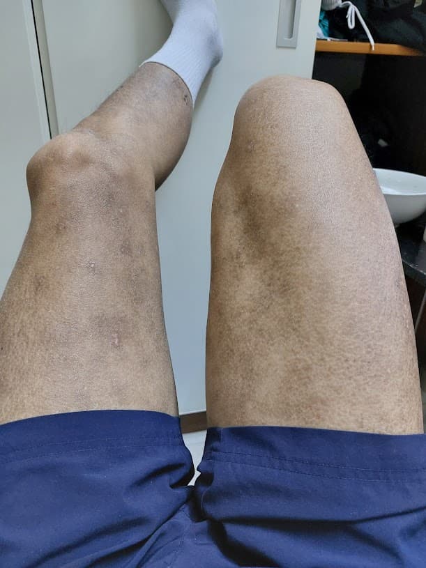 Co the - Sau dieu tri