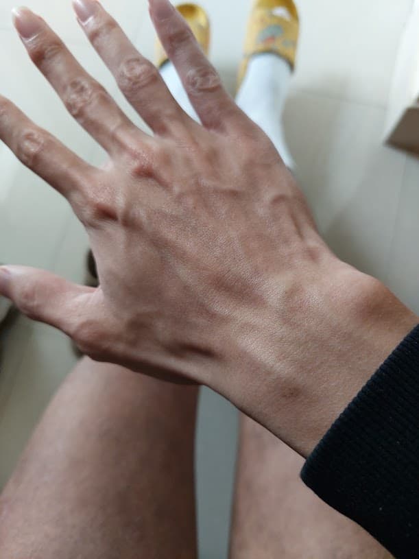 Ban tay - Sau dieu tri